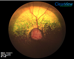 眼底検査